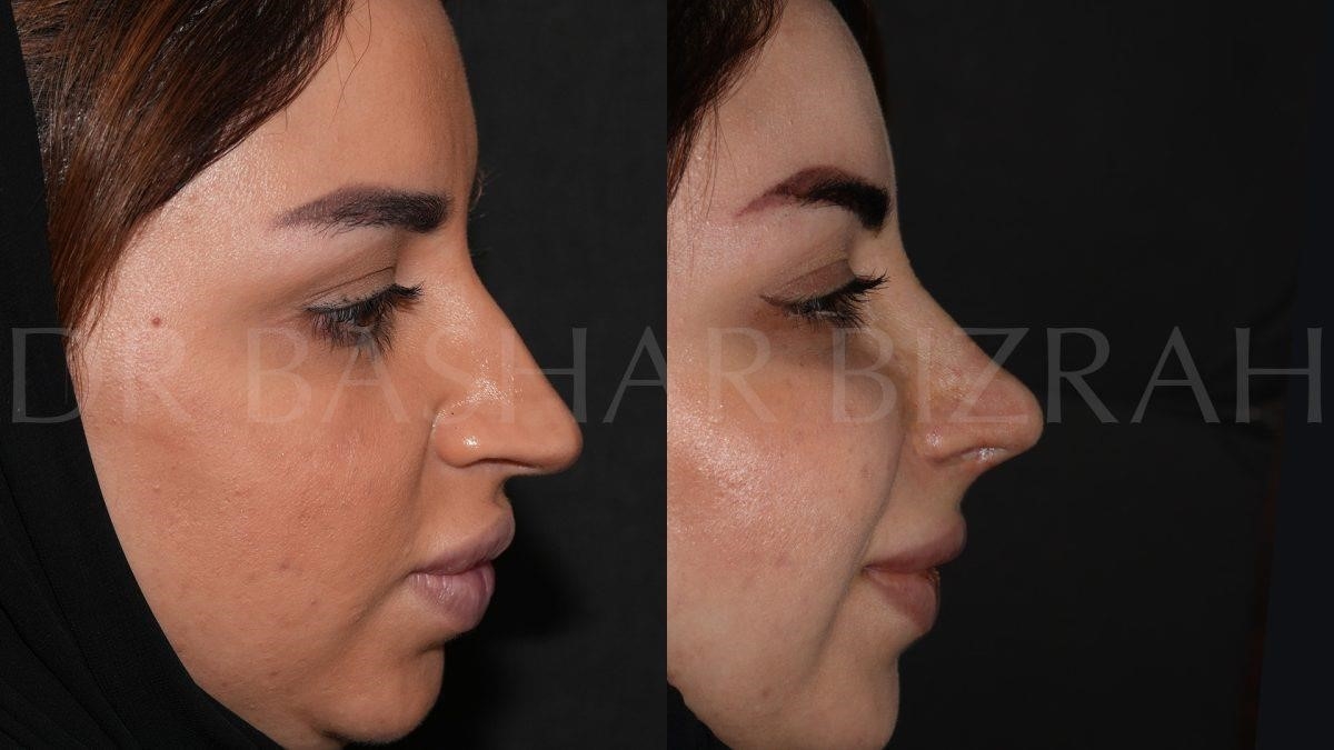 what is a closed rhinoplasty