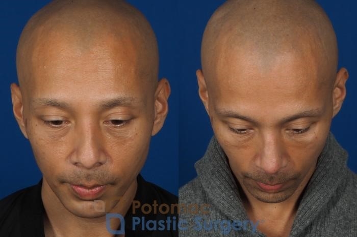 rhinoplasty surgery near me